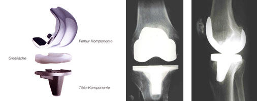 Bikondyläre umgekoppelte Knie-TEP mit Retropatellarersatz